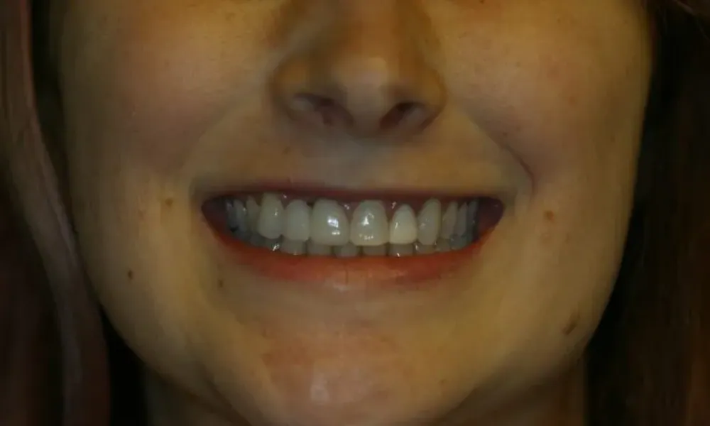 Clinical photo from Hope's smile reconstruction case